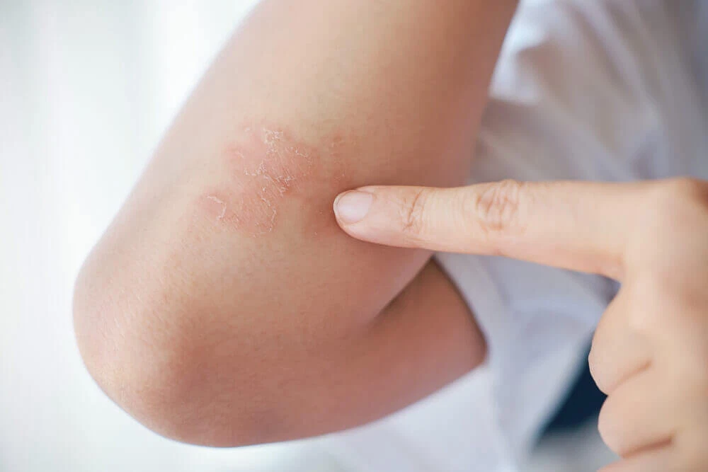 Close-up of dry, flaky skin on an elbow, possibly actinic keratosis.