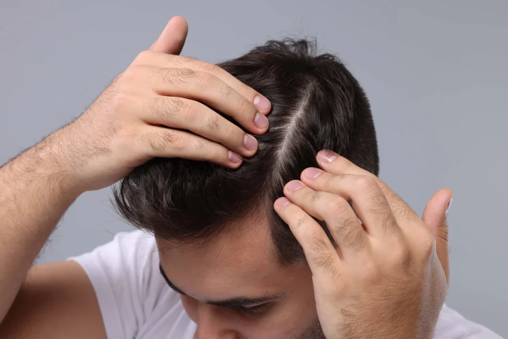 Man parting his hair to examine his scalp for hair loss.