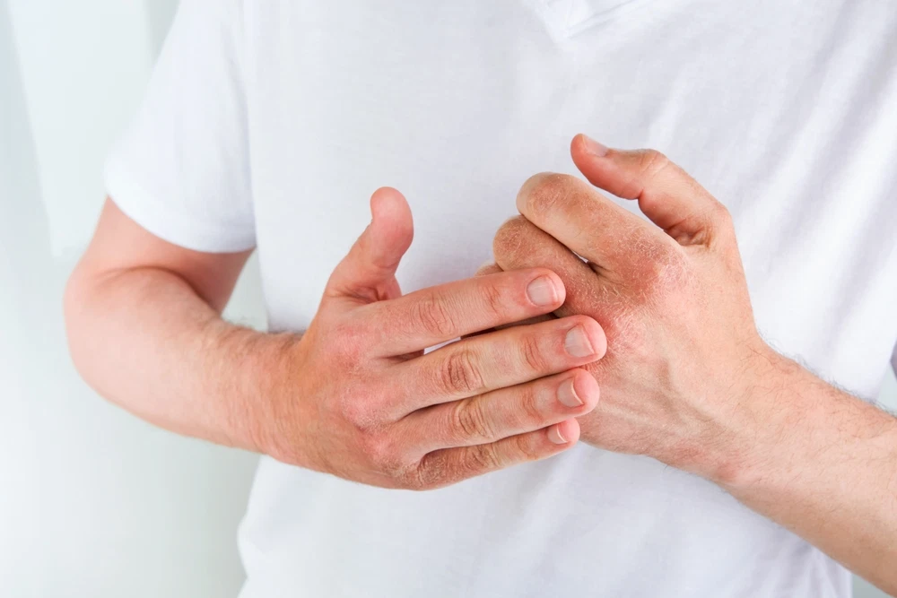 When To See A Dermatologist For Your Eczema