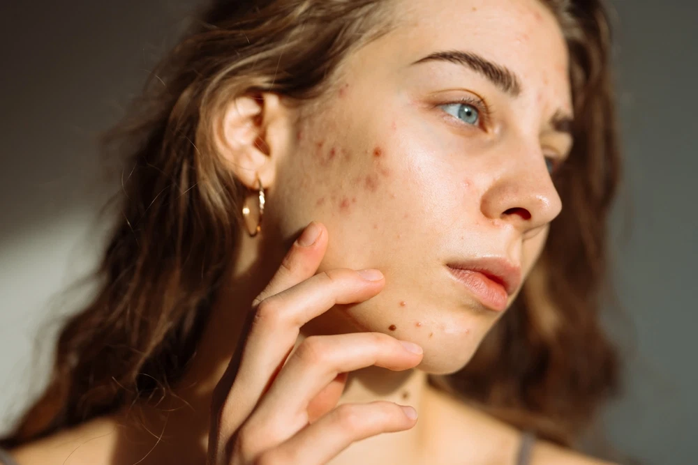 Close-up of a young woman's face showing acne breakouts.