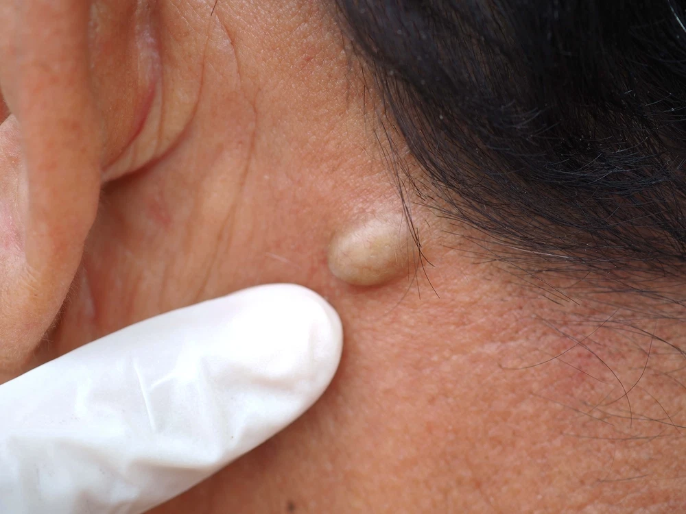 How Dermatology Providers Treat Cysts and Lipomas