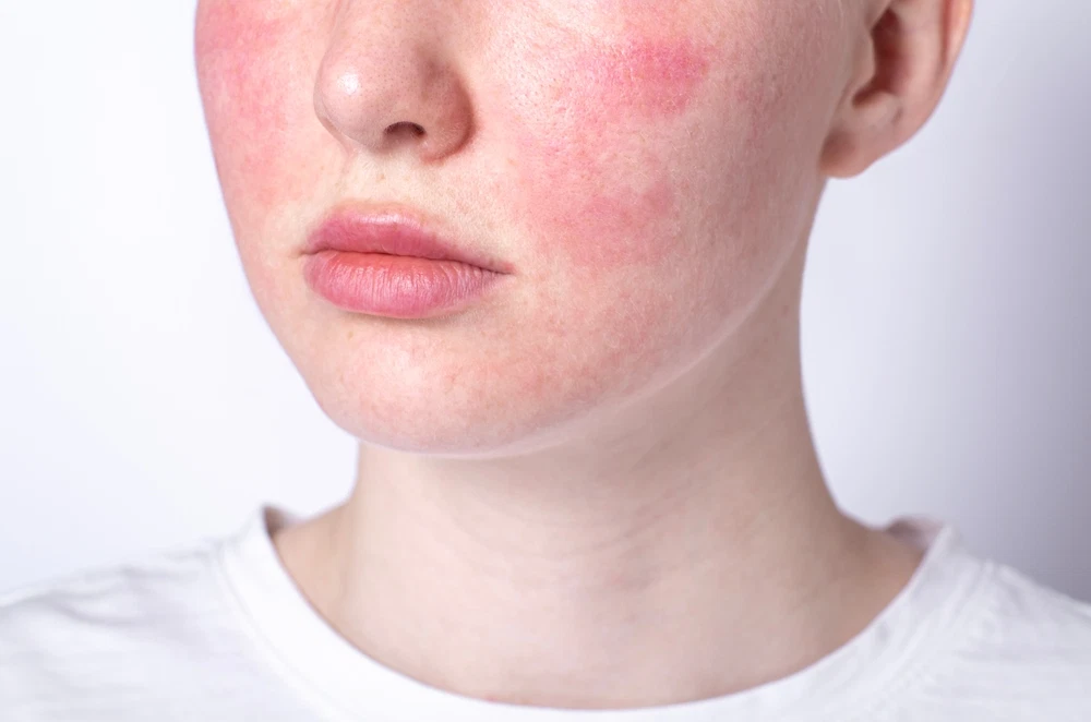 Close-up of a face showing redness and visible blood vessels characteristic of rosacea.