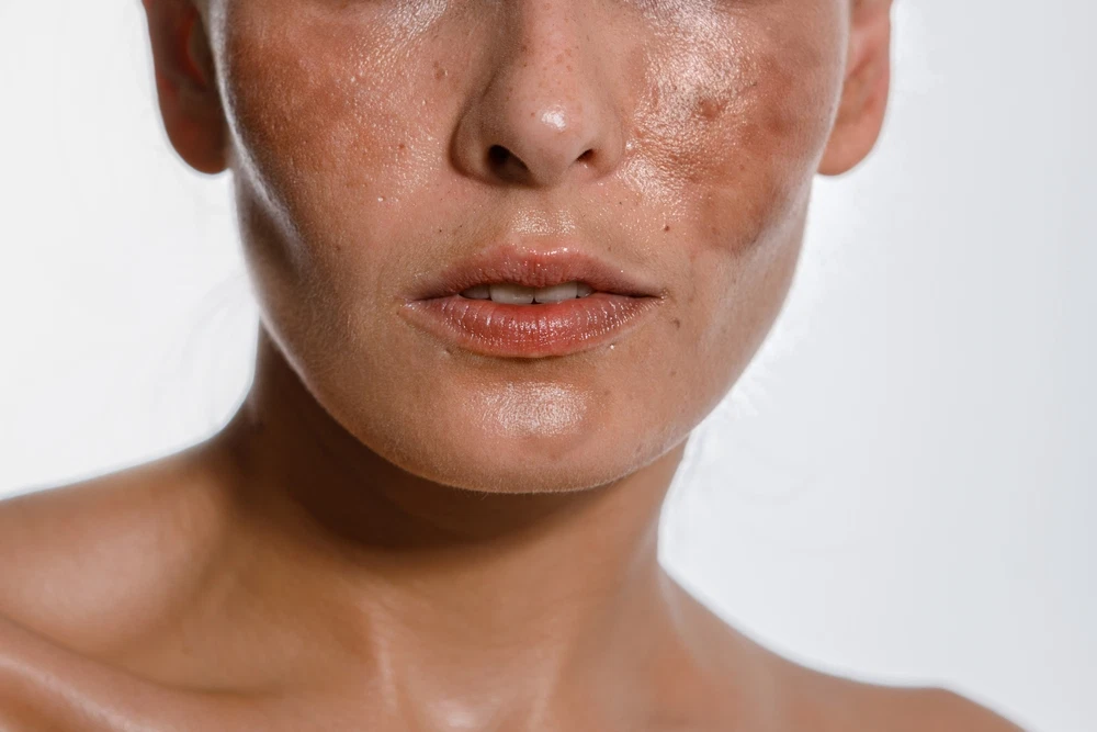 Hyperpigmentation: Causes, Prevention, and Treatments