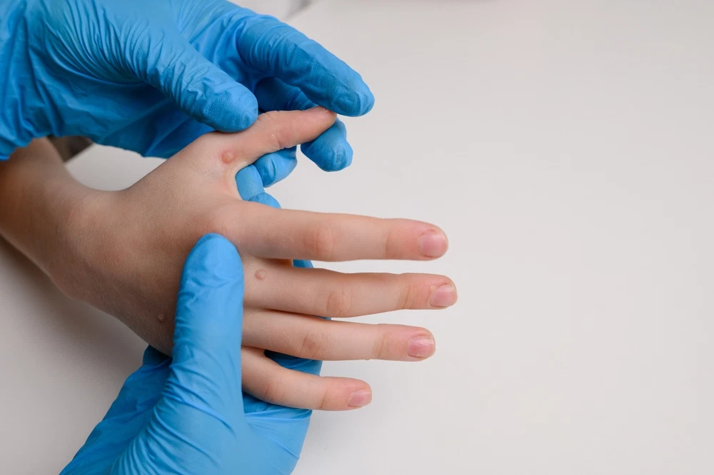 How to Get Rid of Warts Safely