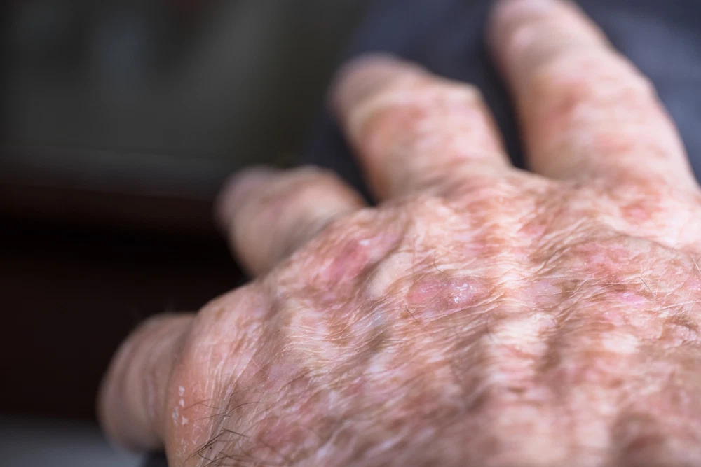 What Is Actinic Keratosis and Why Is It Serious?