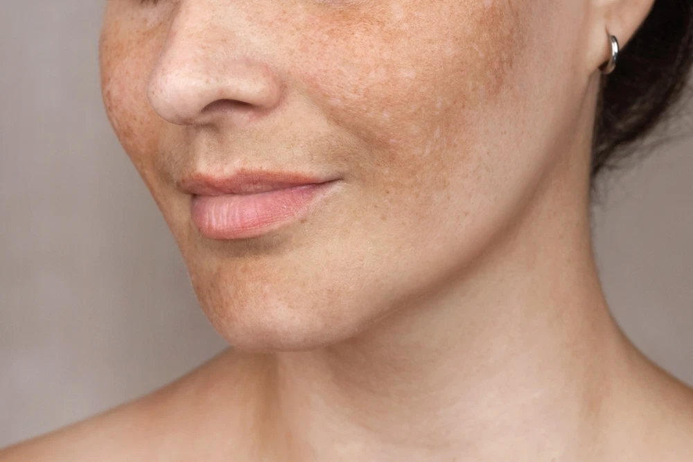 Melasma: Why It Happens and What Can Help