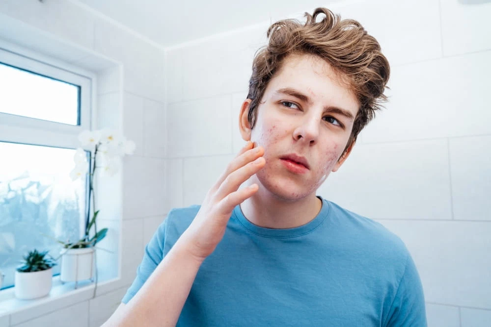 Acne in Teenagers vs. Adults: Different Causes, Different Treatments