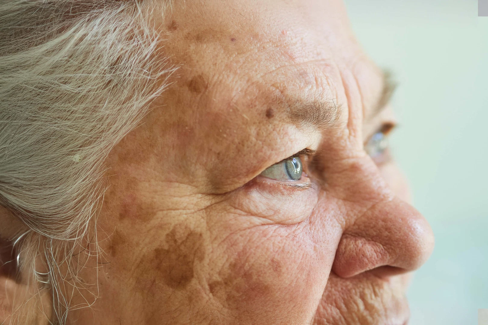 A close-up profile view of an older woman's face, showing signs of actinic keratosis (AK) and age spots.