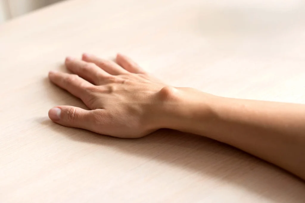 A close-up of a patient's hand and wrist resting on a table with a visible lipoma or cyst.