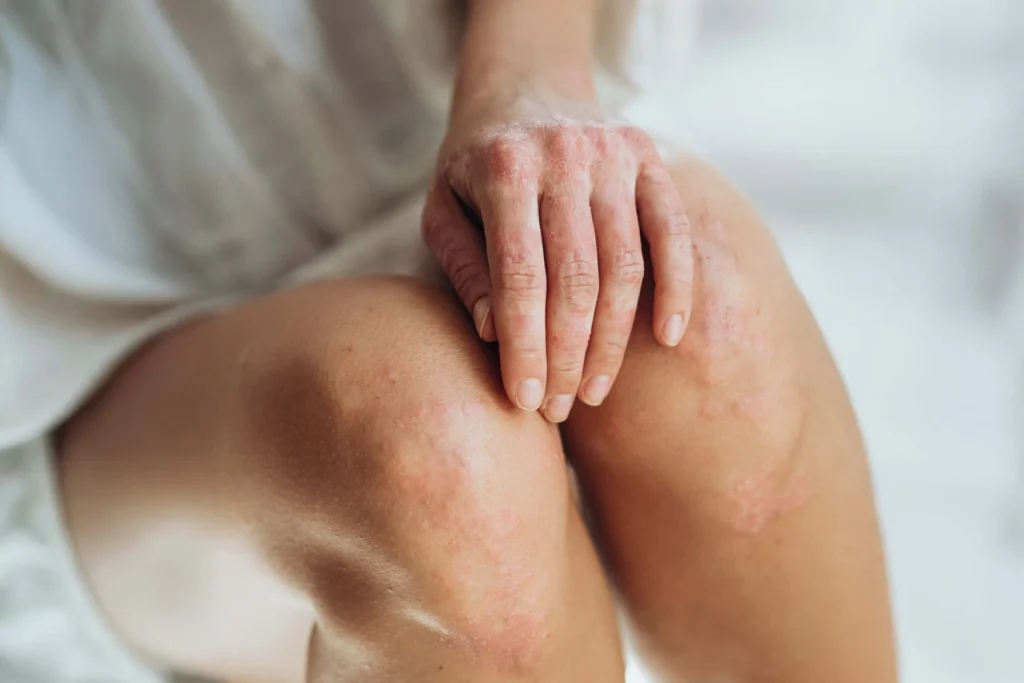 Close-up of a person's hand and knee showing signs of eczema or psoriasis, highlighting skin treatment options.