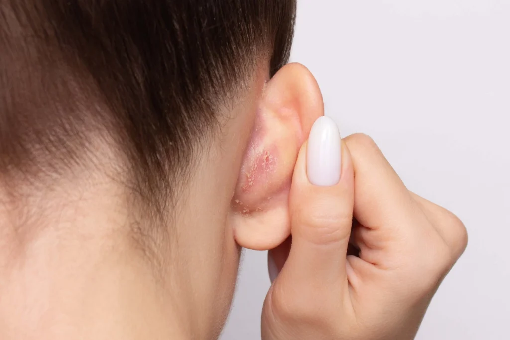 seborrheic dermatitis flare-ups.